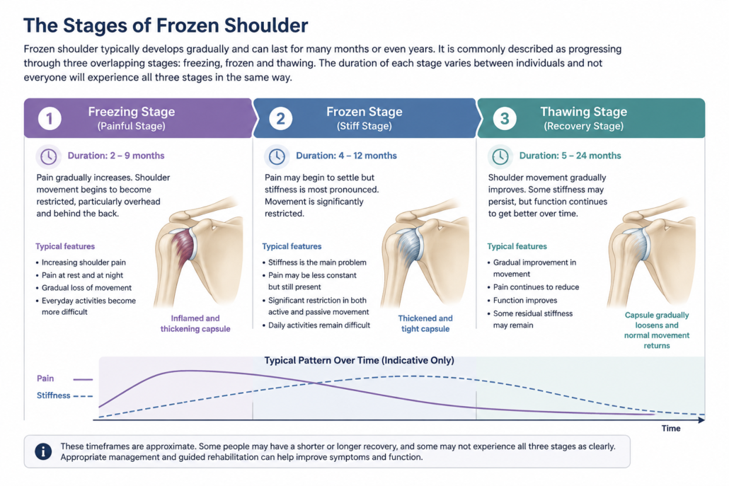 stages-of-frozen-shoulder-adhesive-capsulitis Diagram showing the freezing, frozen and thawing stages of frozen shoulder, including changes in pain, stiffness and shoulder movement.
